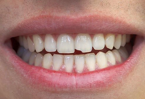 toothache photo