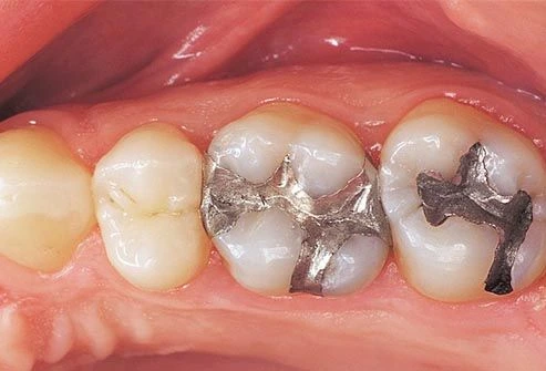 toothache photo