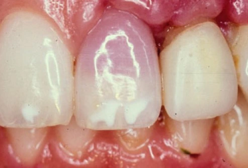 toothache photo