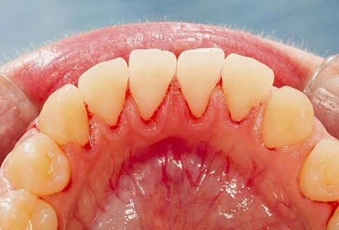 toothache photo