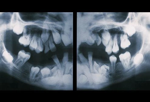 toothache photo