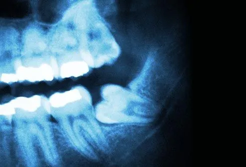 toothache photo