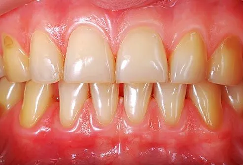 toothache photo